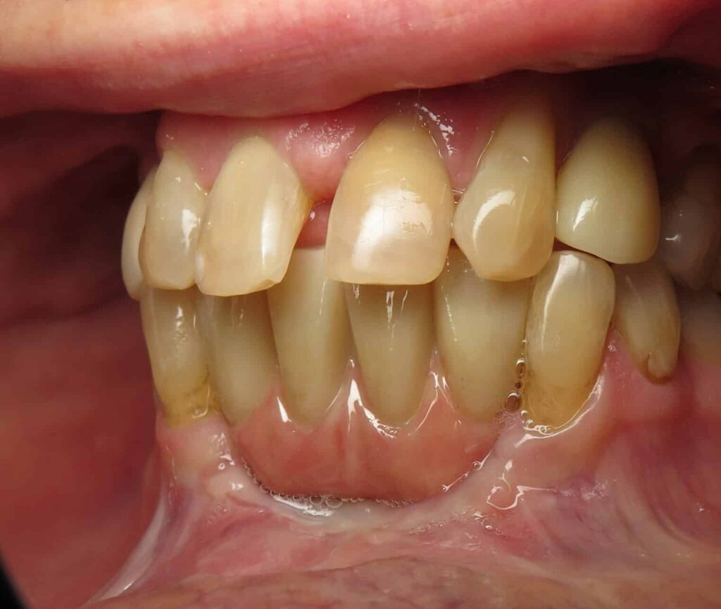 Lower front teeth dental implant bridge placed side profile view