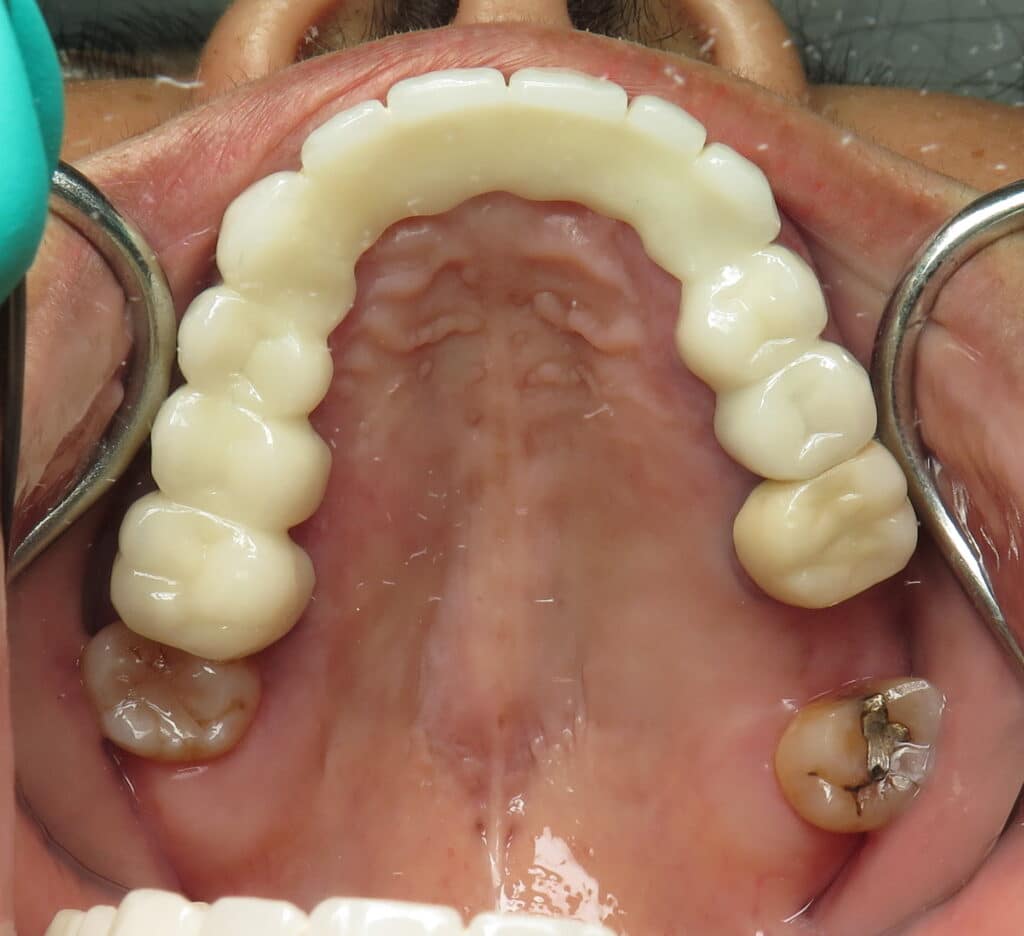 Original failing loose upper bridge. Please note that the upper front teeth are sitting off of the main gums to make it look like she has a normal bite rather than a genetic under bite.