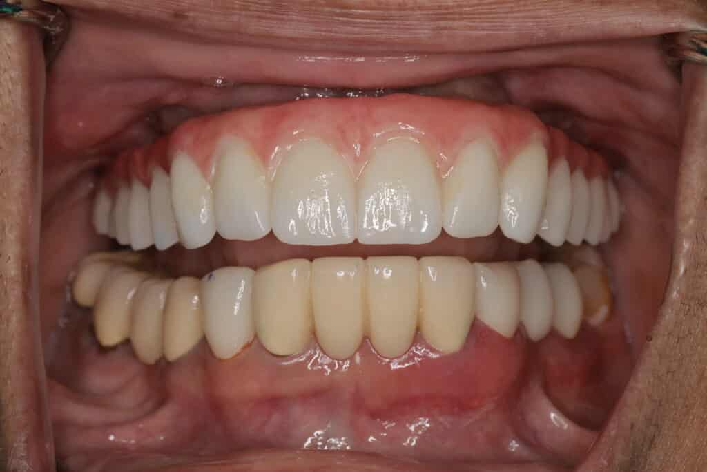 full arch implant case - Front view dental implant bridge all on 6 zygomatic and pterygoid implants made in zirconia