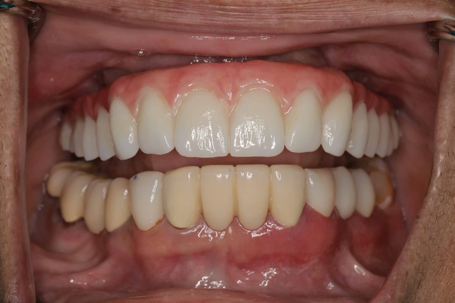 Full Arch Implant A Difficult Case Explained (No Bone, Underbite)