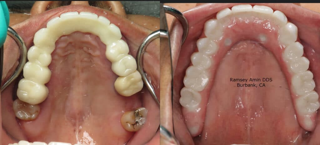 full arch implant case - This bridge HAD to be made this thick due to lip support and underbite.