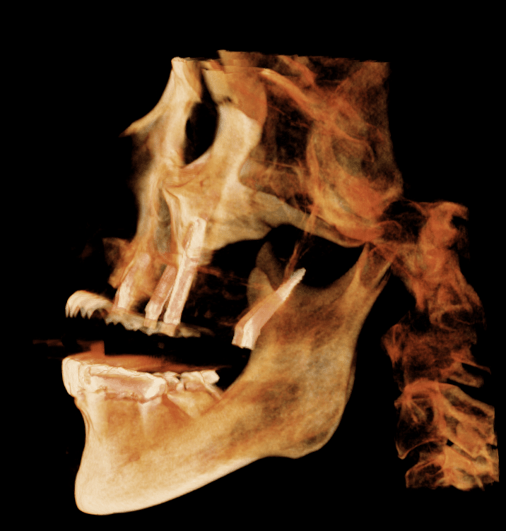 Side view 3D showing zygomatic/pterygoid implants in a patient with an under bite leading to increased use of artificial gum