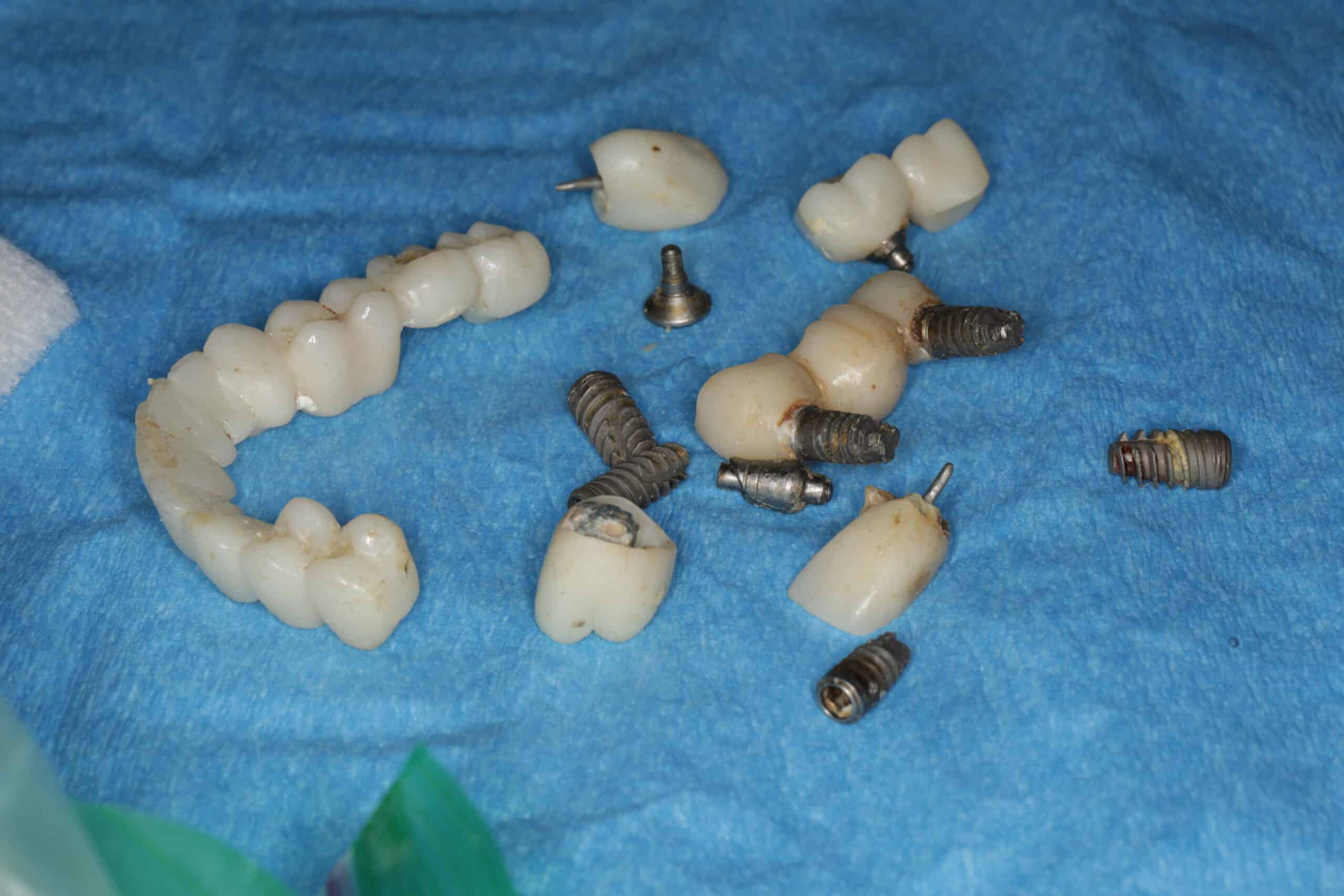 Failed dental implants after only 2 years