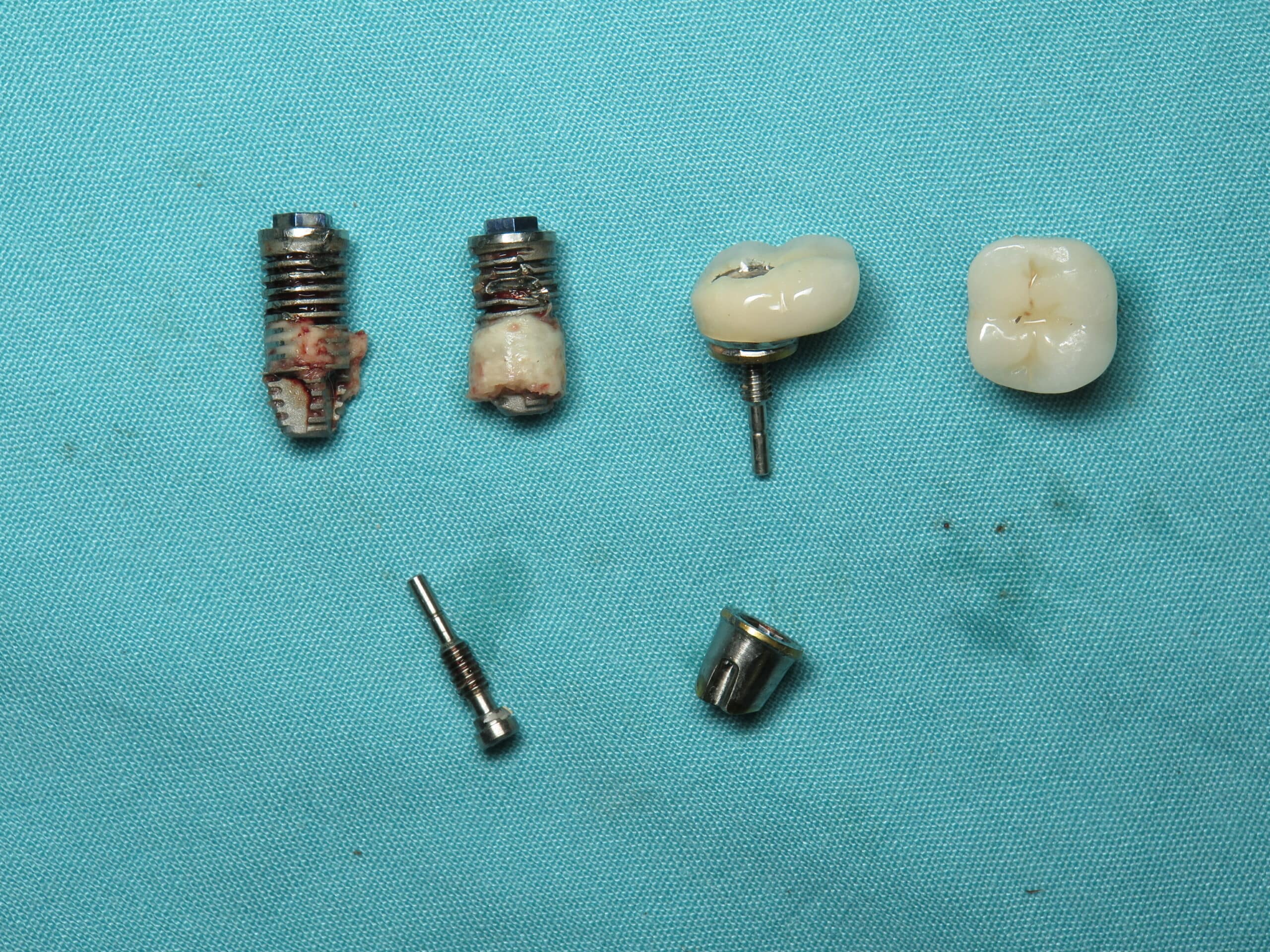 Dental Tourism implants removed. failed dental implants that Ramsey Amin DDS removed.