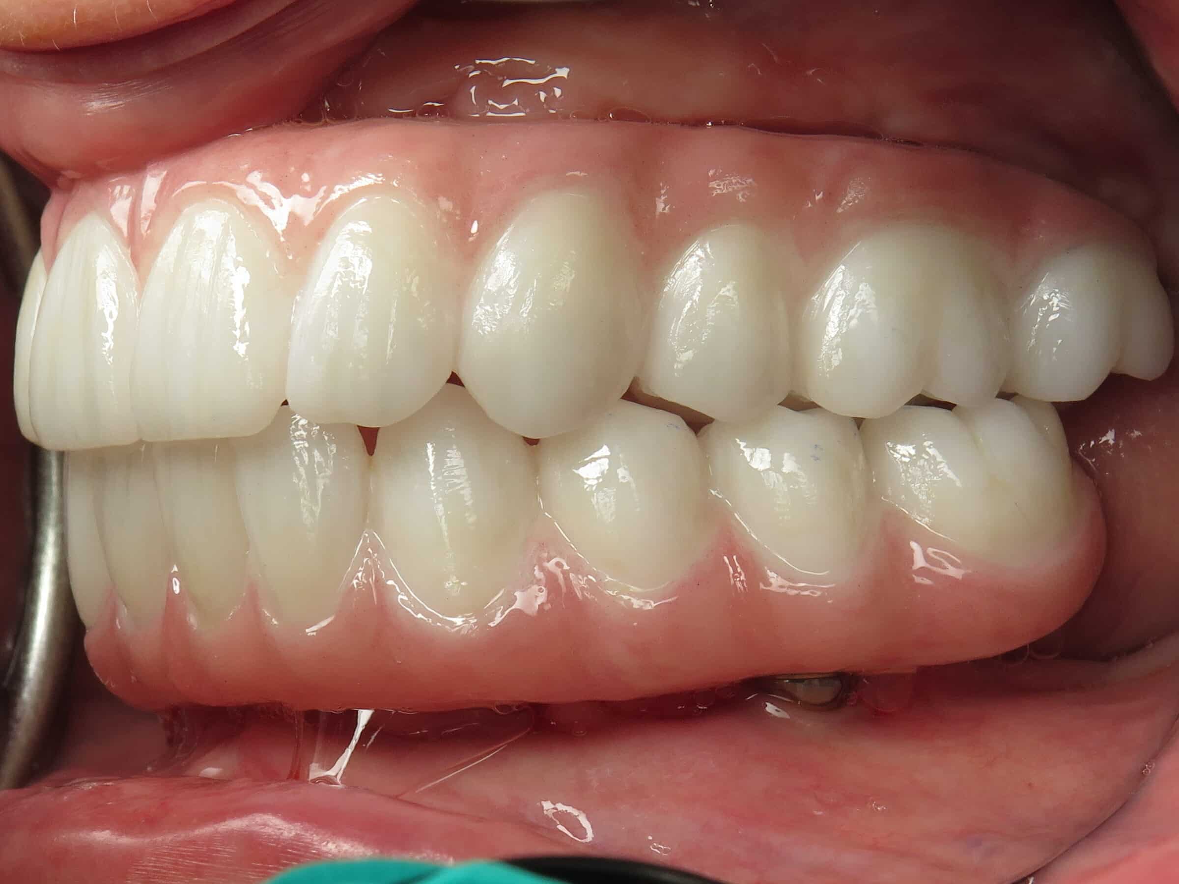 After photo of all on 4 implants and zygomatic implants by Dr. Ramsey Amin of Burbank Dental Implants