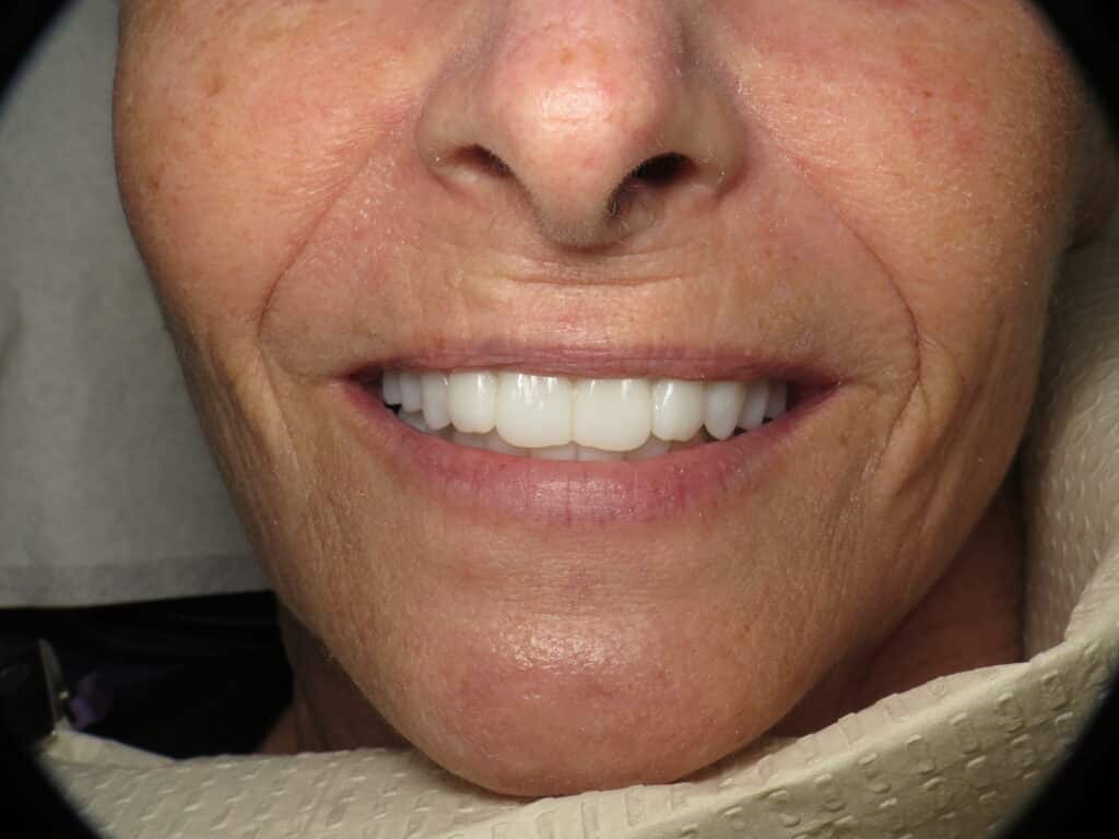 After photo of patient smiling with all on 4 implants and zygomatic implants by Dr. Ramsey Amin of Burbank Dental Implants