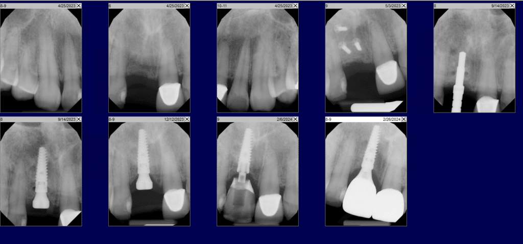 Block bone graft x-ray series. Image by Ramsey Amin DDS of Burbank Dental Implants