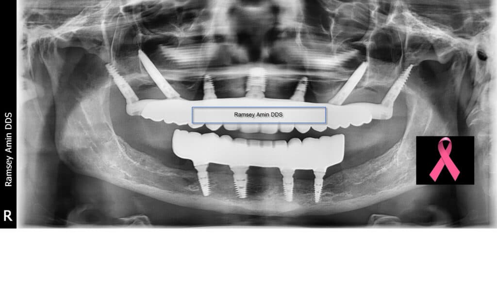 cancer dental full mouth implants x ray treated by ramsey amin dds