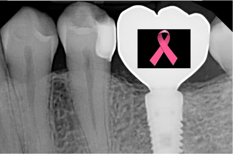 cancer dental implant xray