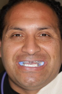 Measuring the bite for full mouth dental implants