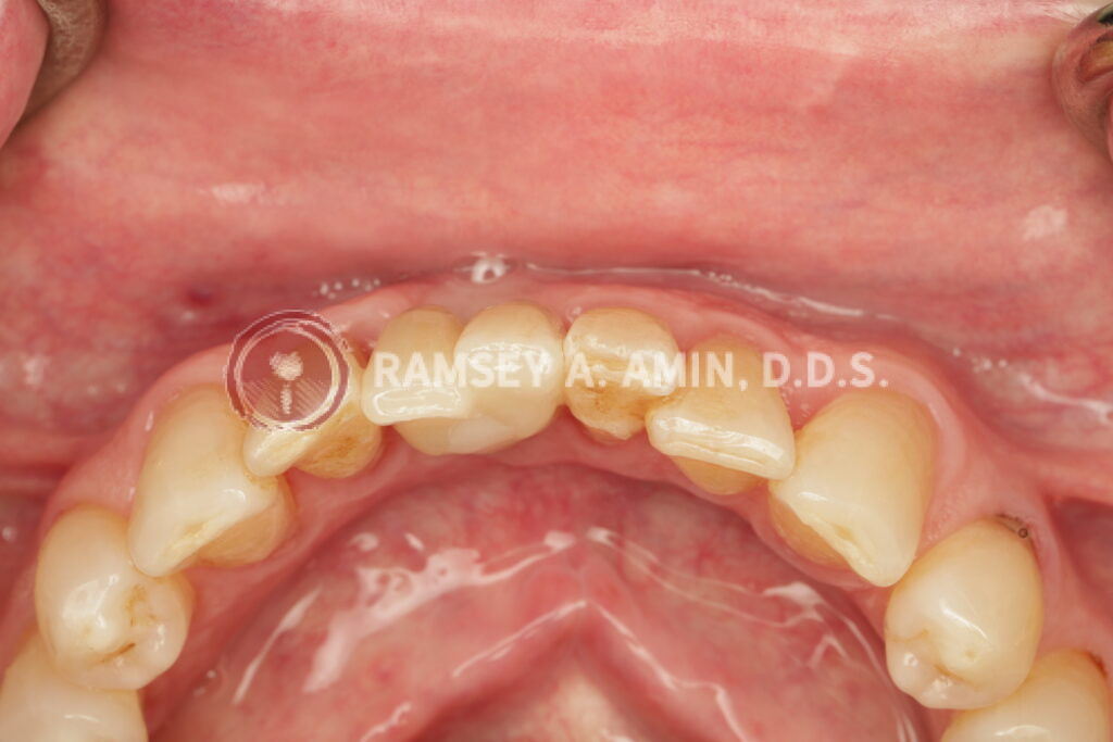 Lower front tooth double implant