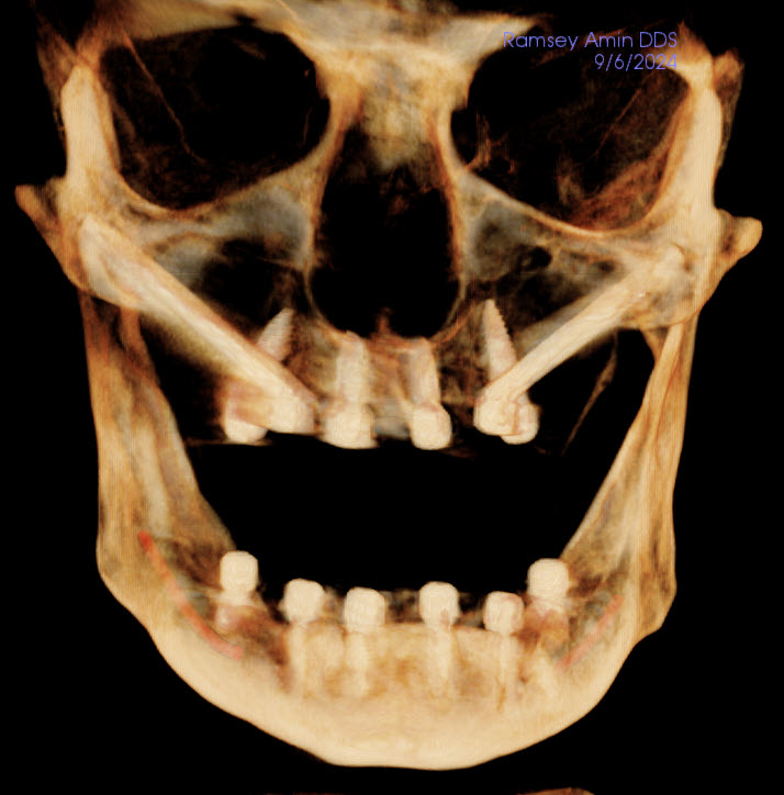 3D zygomatic and pterygoid implants