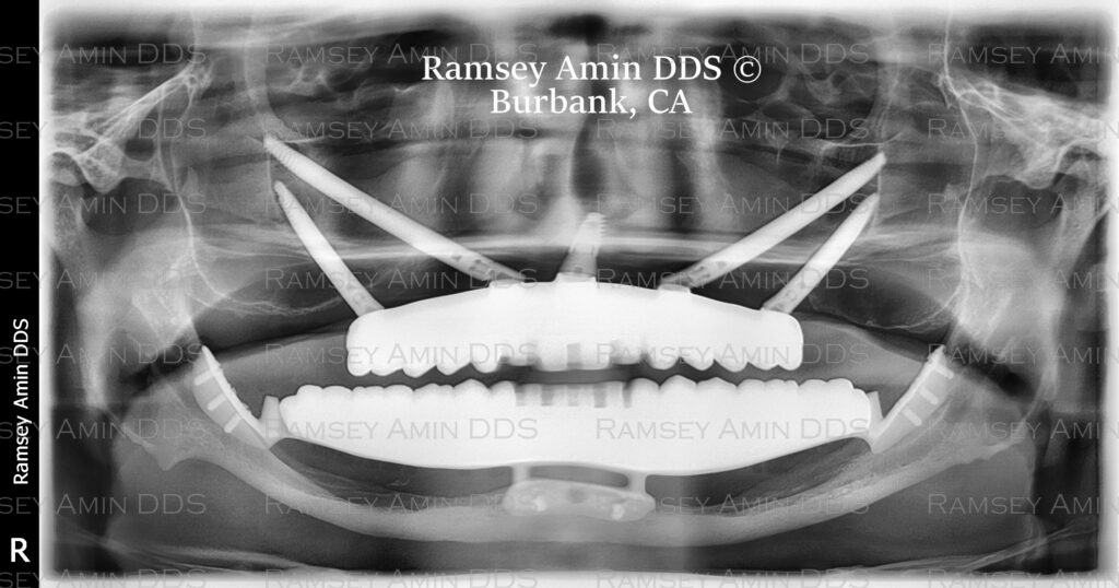 Quad Zygomatic Implants and Lower Custom Subperiosteal Dental Implant