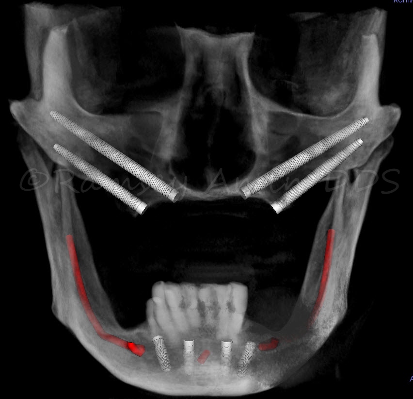Quad zygoma zygomatic implants