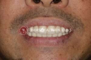 after photo of a straight smile from Dr. Ramsey Amin