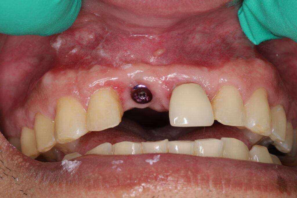 Dental implant healing abutment