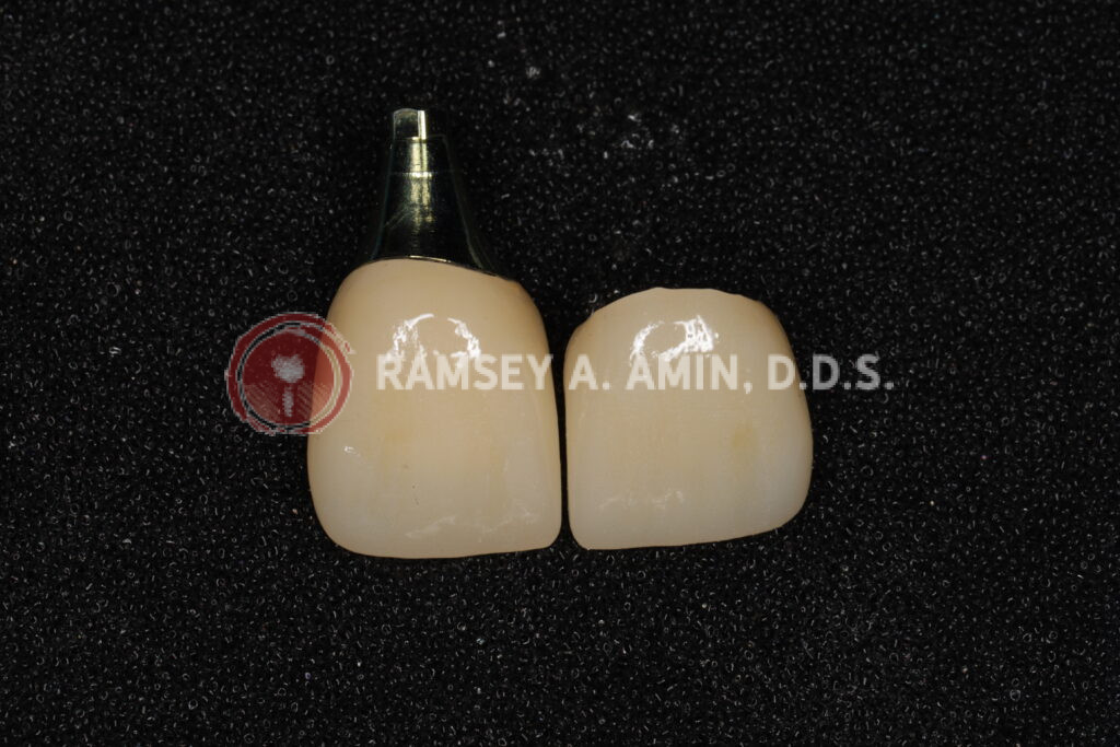 Final dental implant tooth on the left/ Regular Crown on right - Lab Work