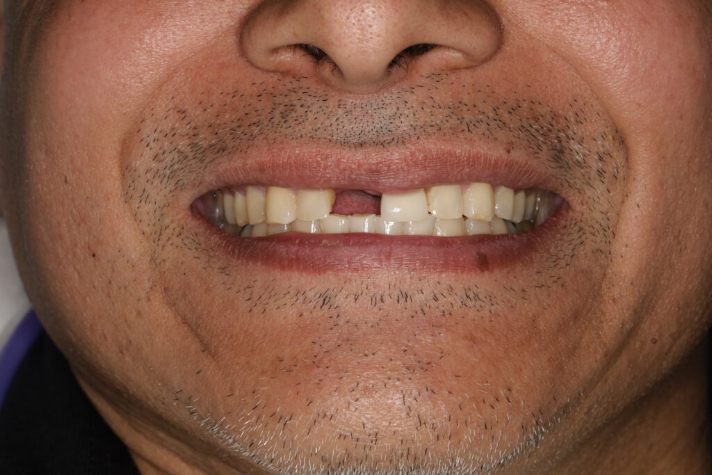 Missing front tooth