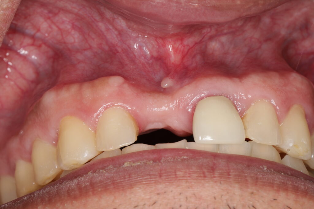 Dent in bone (direct view). Image by Ramsey Amin DDS of Burbank Dental Implants