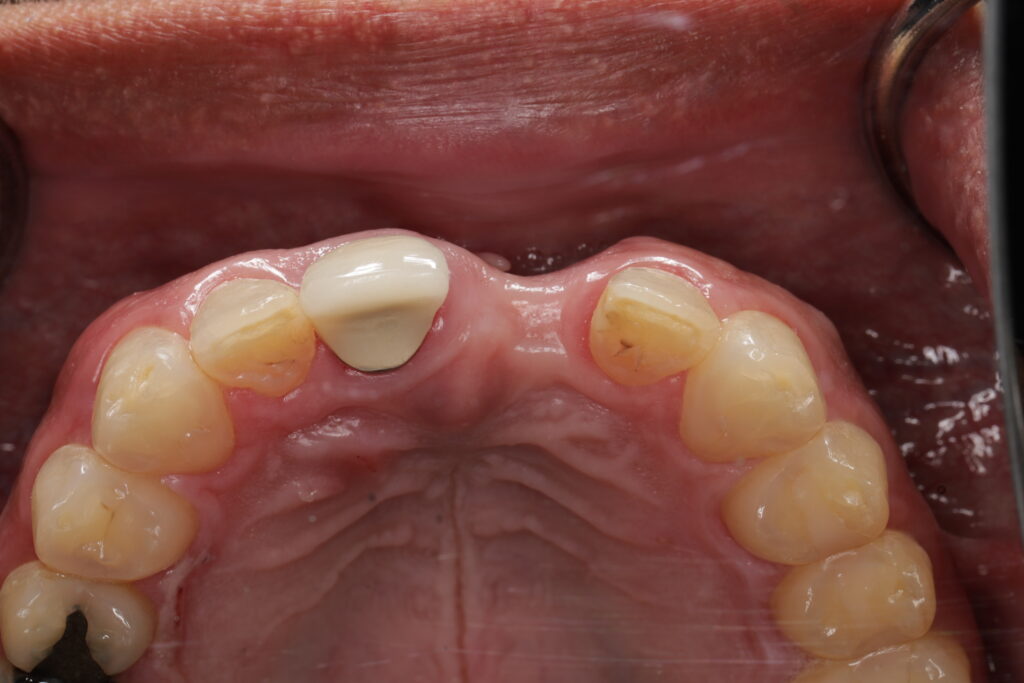 Dent in bone (mirror view)