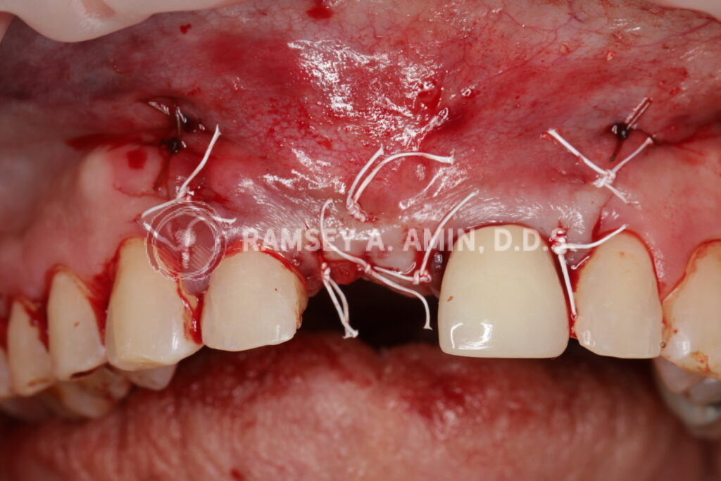 Implant surgery and stitches