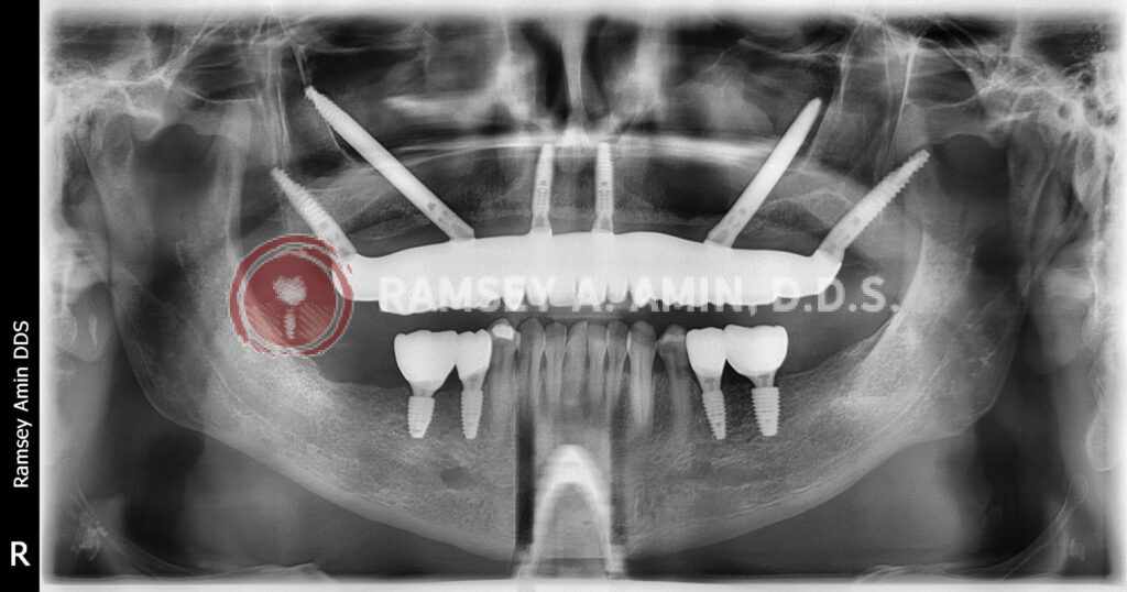 Full Upper Implants with Lower Molar Dental Implants X-ray