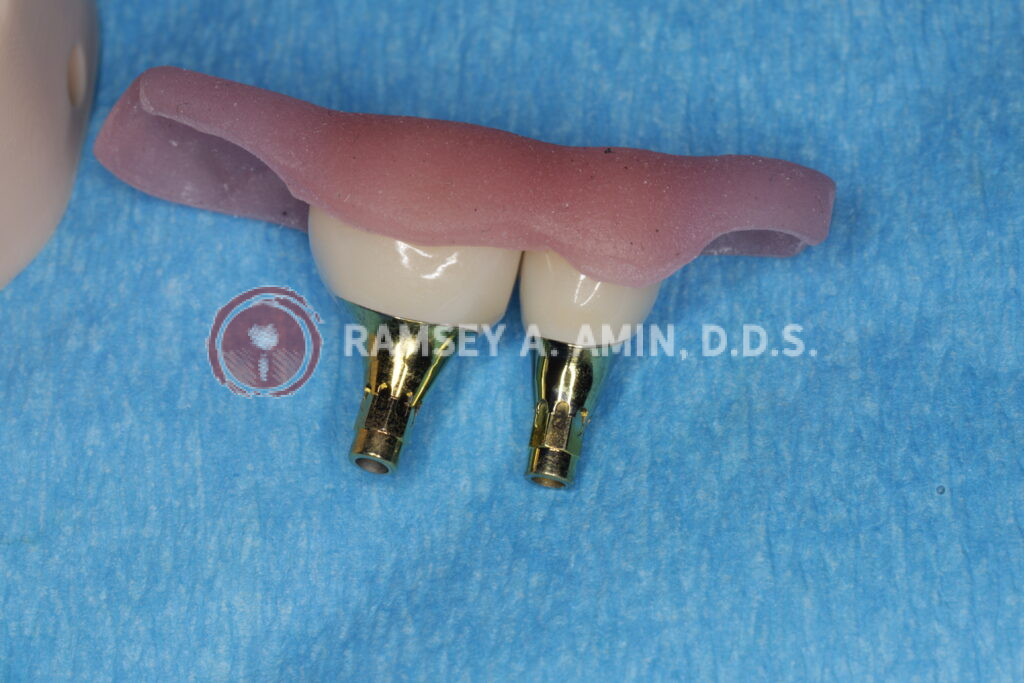 Molar and Premolar Dental Implant with Custom Abutments