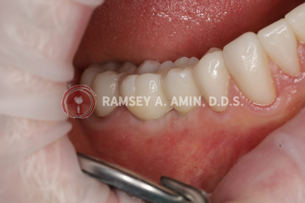 Molar and Premolar Dental Implant