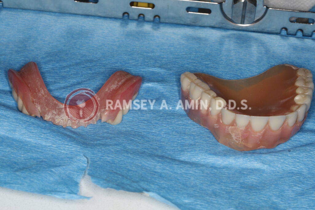 failing upper dental implant snap-on overdenture - photo by Ramsey Amin DDS of Burbank Dental Implants