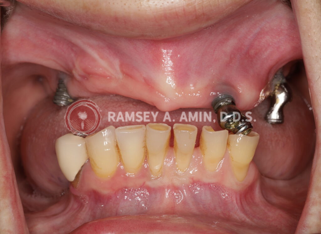 failing upper dental implant overdenture - a patient of Ramsey Amin DDS of Burbank Dental Implants