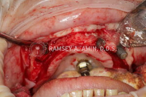 Failing broken dental implants - photo by Dr. Ramsey Amin of Burbank Dental Implants
