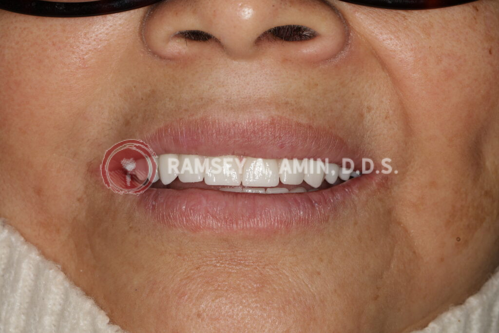 dental implant smile example by Ramsey Amin DDS of Burbank Dental Implants