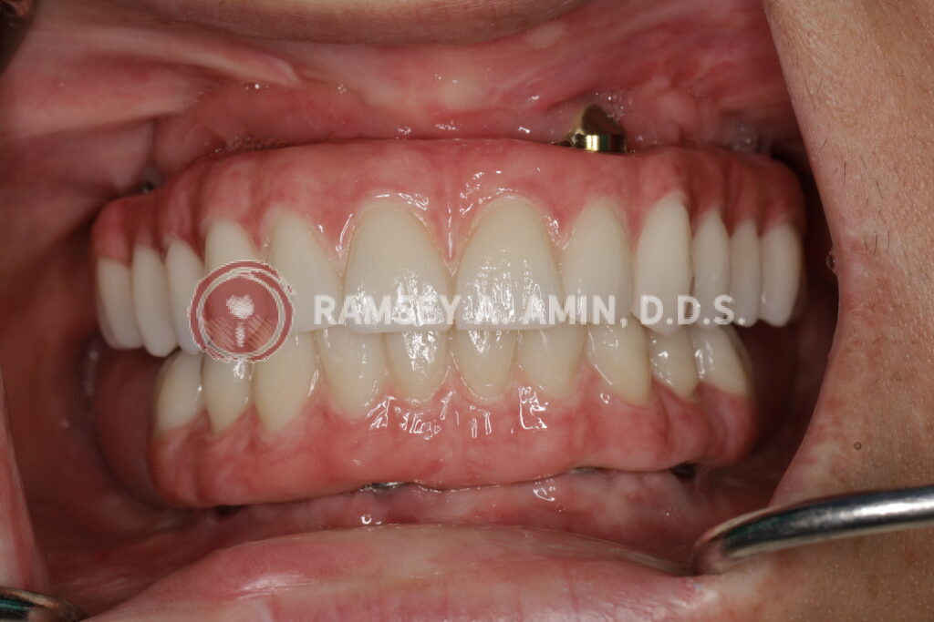 beautiful dental implant smile - patient of Ramsey Amin DDS of Burbank Dental Implants