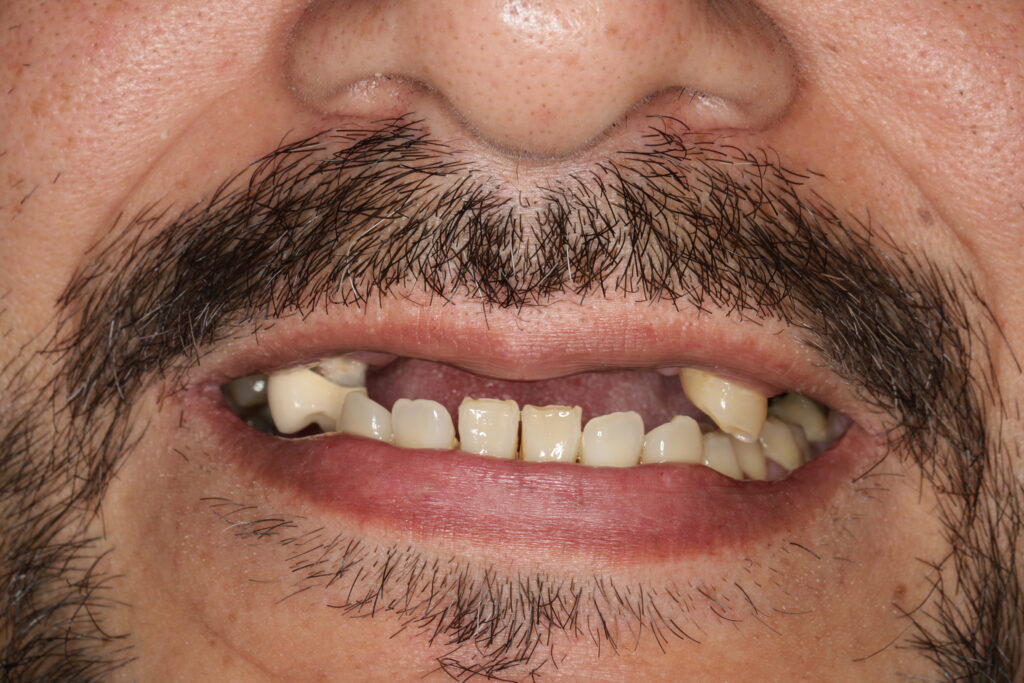 Smile without teeth showing over closed bite