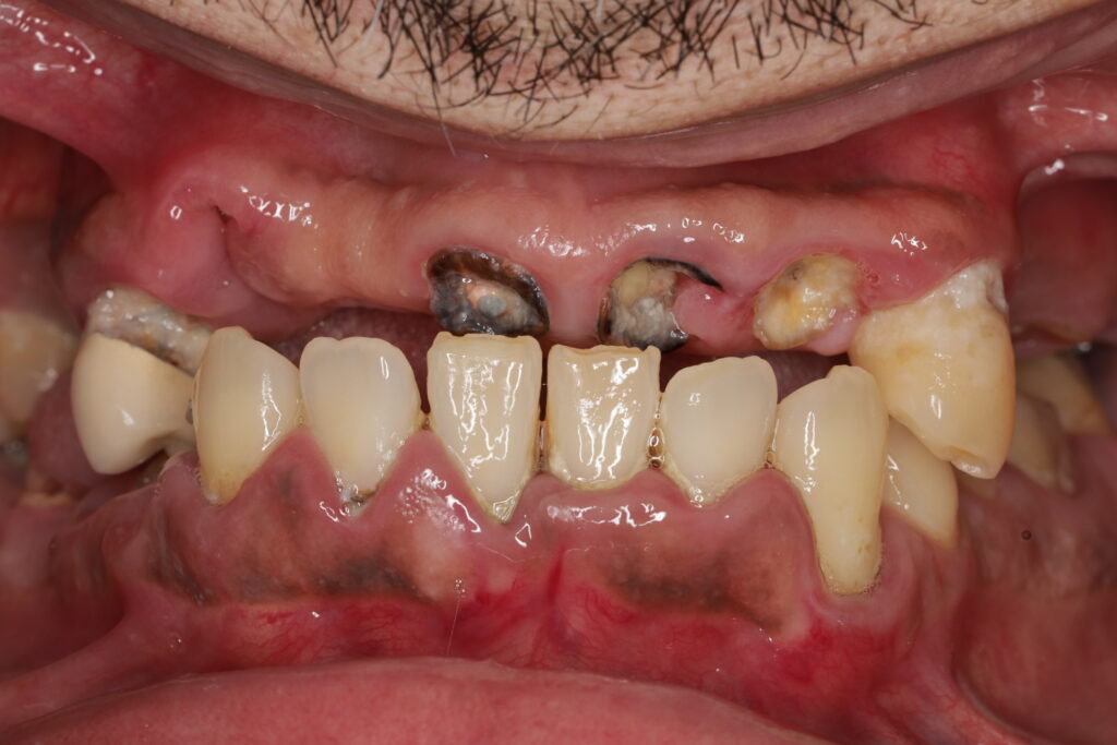 Missing and decayed teeth showing over closed bite