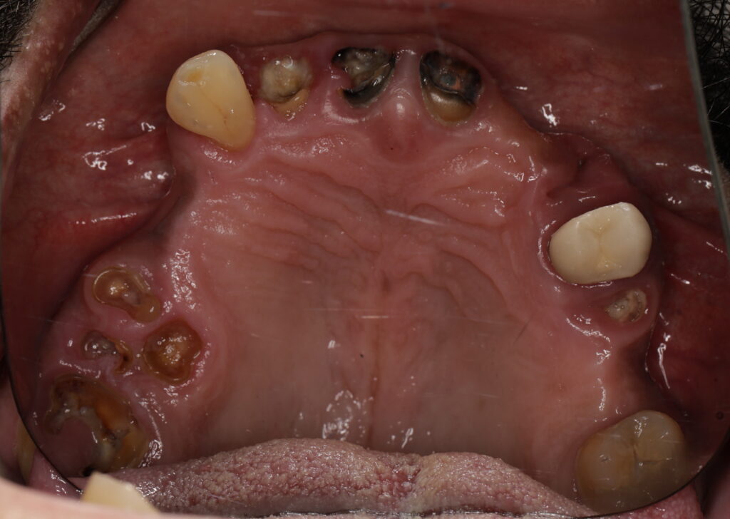 Top view showing severe decay, missing, and broken teeth. Gum disease present.