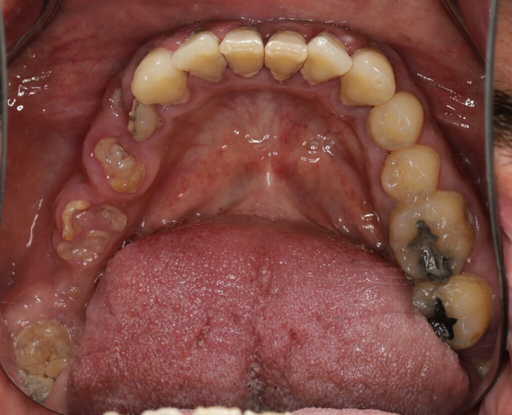 Top view showing severe decay, missing, and broken teeth. Gum disease present.