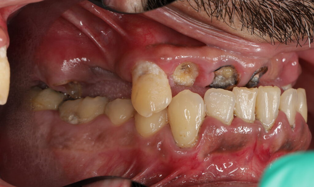 Side view showing severe decay, missing, and broken teeth