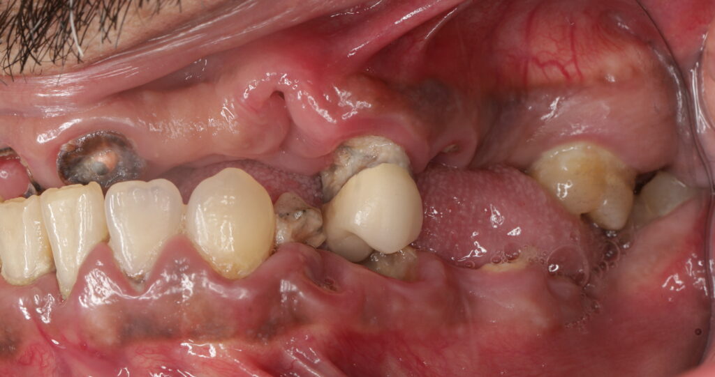 Side view showing severe decay, missing, and broken teeth