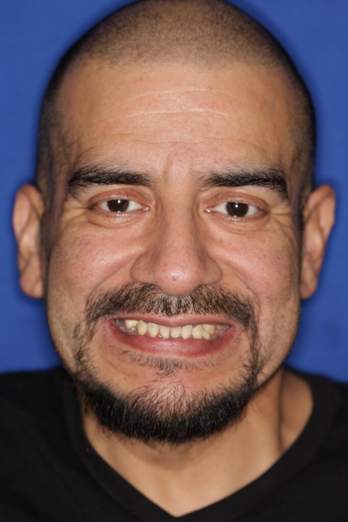 Smile without teeth showing over closed bite
