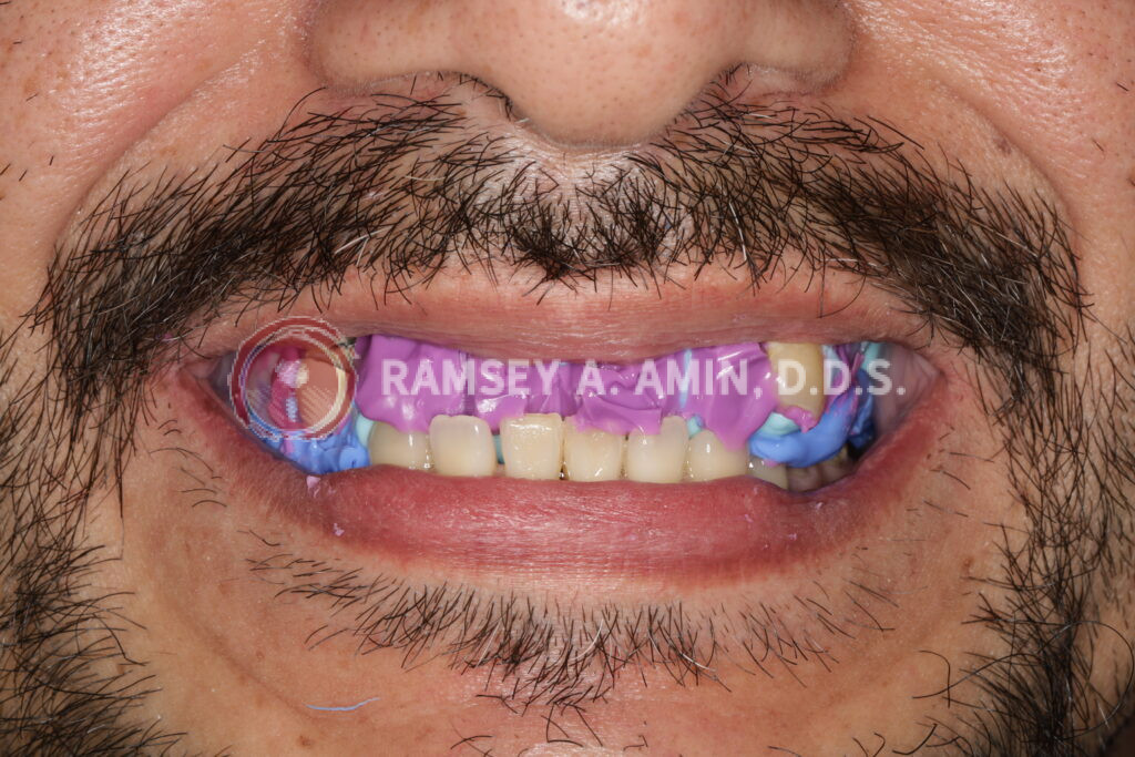 Facial measurement jig to analyze smile and bite dimensions