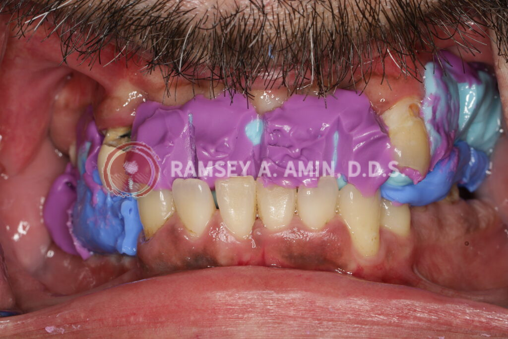 Facial measurement jig to analyze smile and bite dimensions