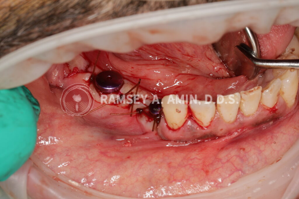 Lower dental implants by Dr. Amin of Burbank Dental Implants