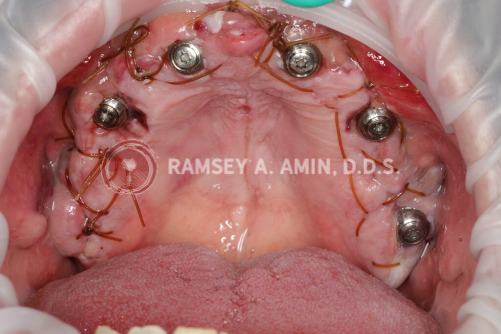 Full upper dental implant surgery the very next day showing dissolvable stitches in place
