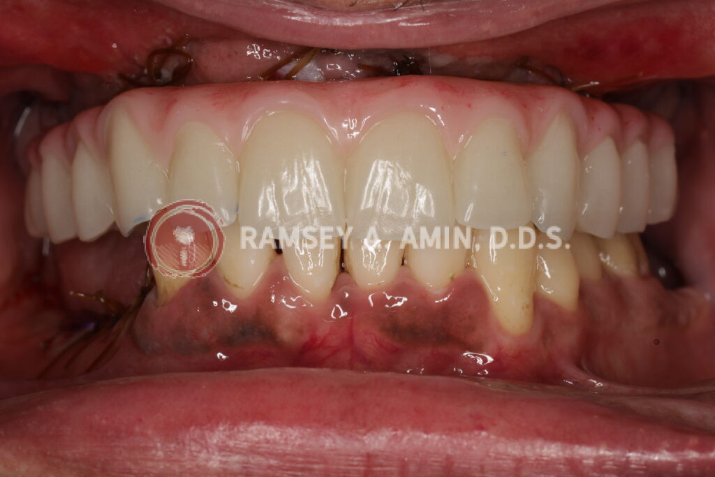 Next day plastic milled upper implants healing teeth temporary prototypes delivered 1 day after surgery. Patient wears these for 3 months