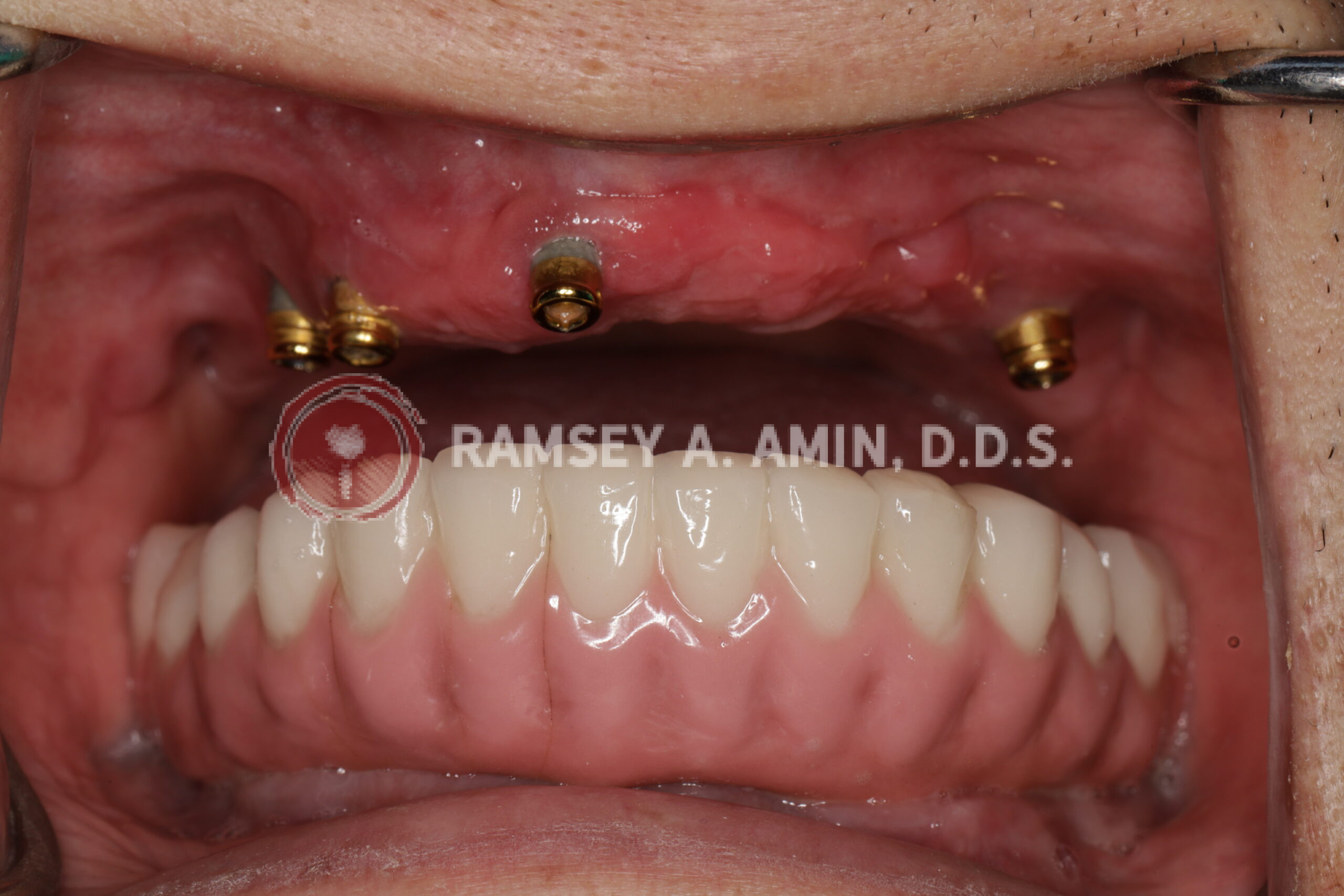 Failing Upper Implant Overdenture