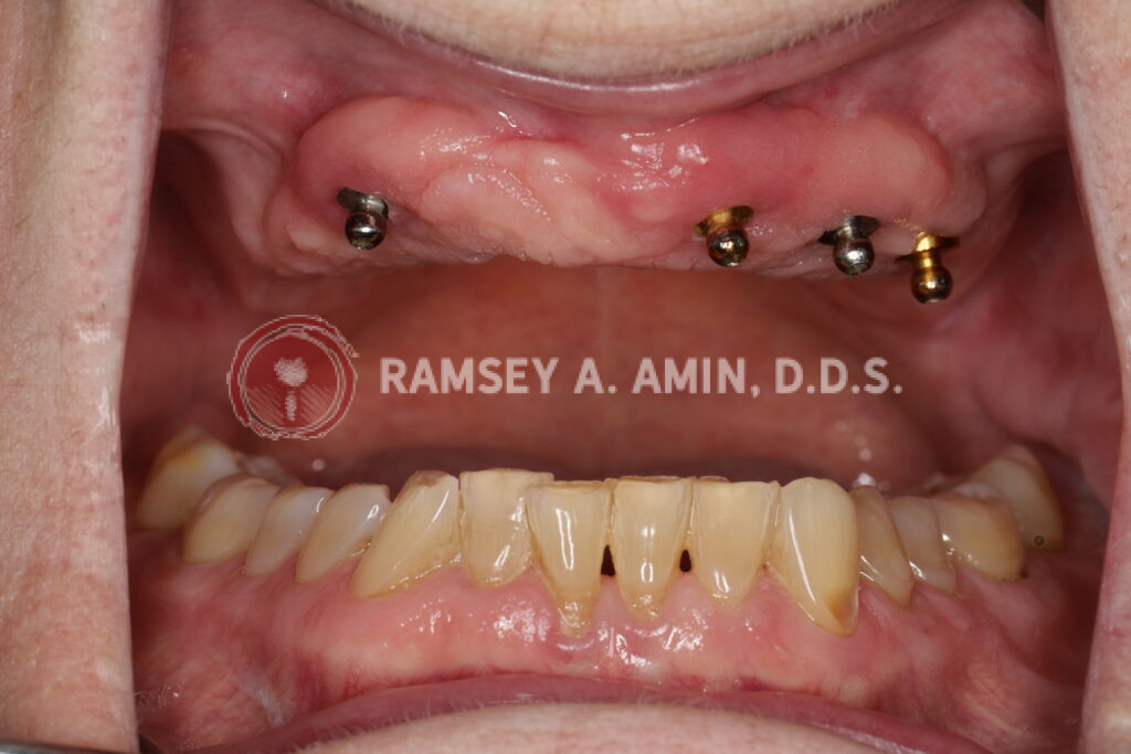 dental implants all on 4 by Ramsey Amin DDS