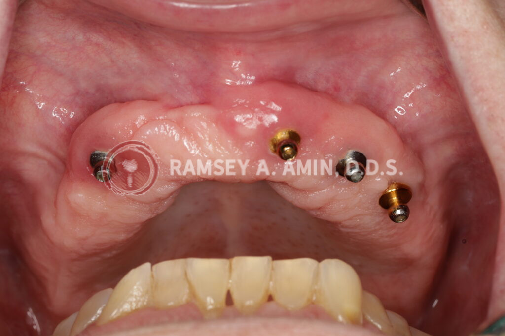dental implant case by Ramsey Amin DDS