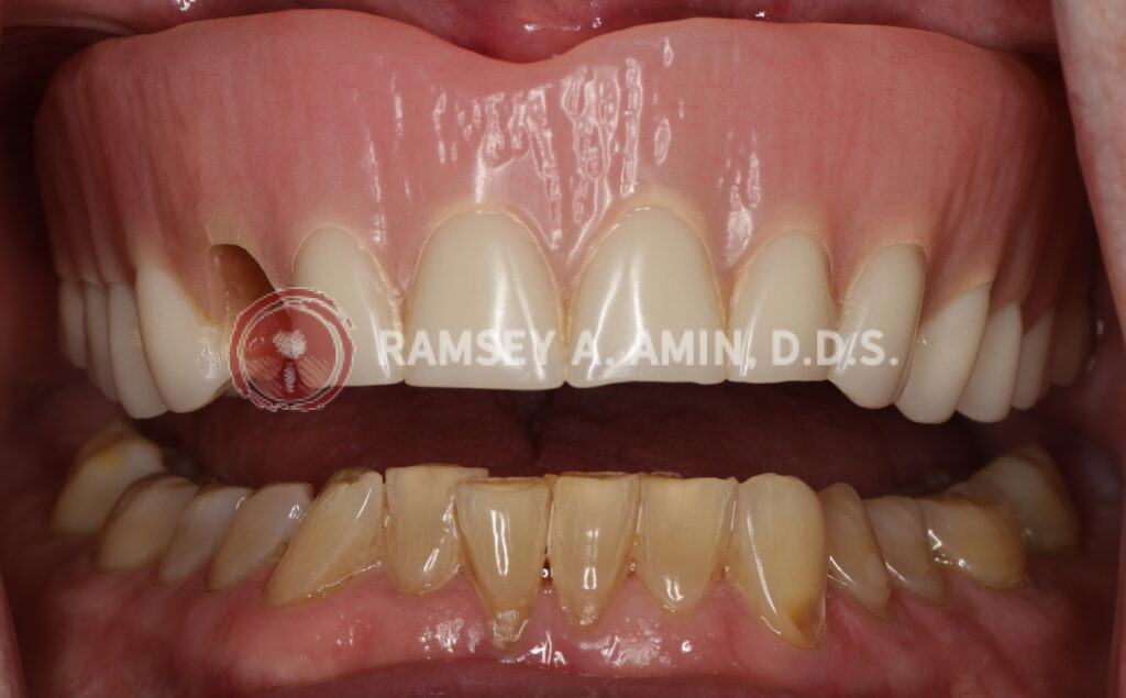 dental implant smile