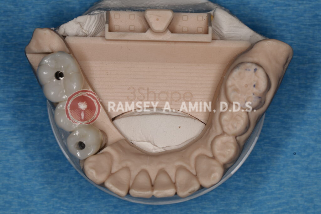 Lower right dental implant 3 tooth bridge -Ramsey Amin, DDS